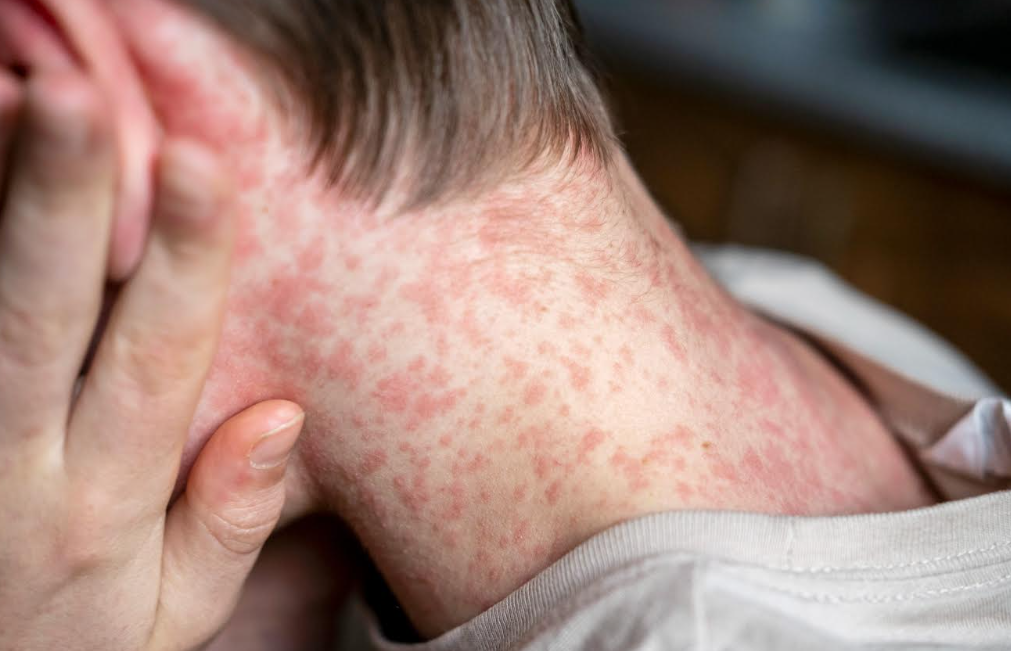 Dokter Spesialis Anak Warning Waspada Campak, Upaya Melindungi Anak dan Keluarga