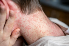 Dokter Spesialis Anak Warning Waspada Campak, Upaya Melindungi Anak dan Keluarga